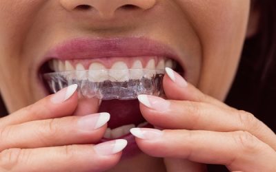 Ortodonzia invisibile: il futuro dei trattamenti correttivi è qui