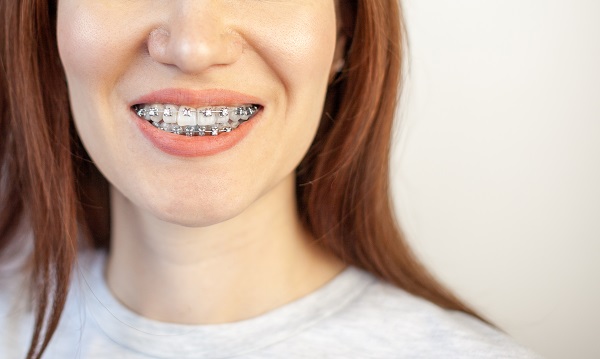 Trattamento di una malocclusione con l'apparecchio fisso.
