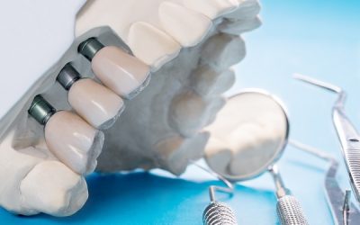 Implantologia 4.0: materiali e tecniche all’avanguardia per un sorriso perfetto