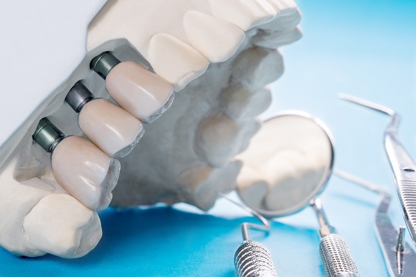 Impianti dentali.