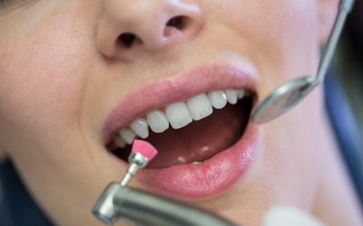 Placca batterica: come si forma e come eliminarla in modo efficace