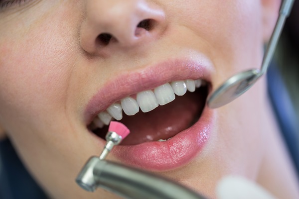 Pulizia dei denti professionale per eliminare la placca batterica.
